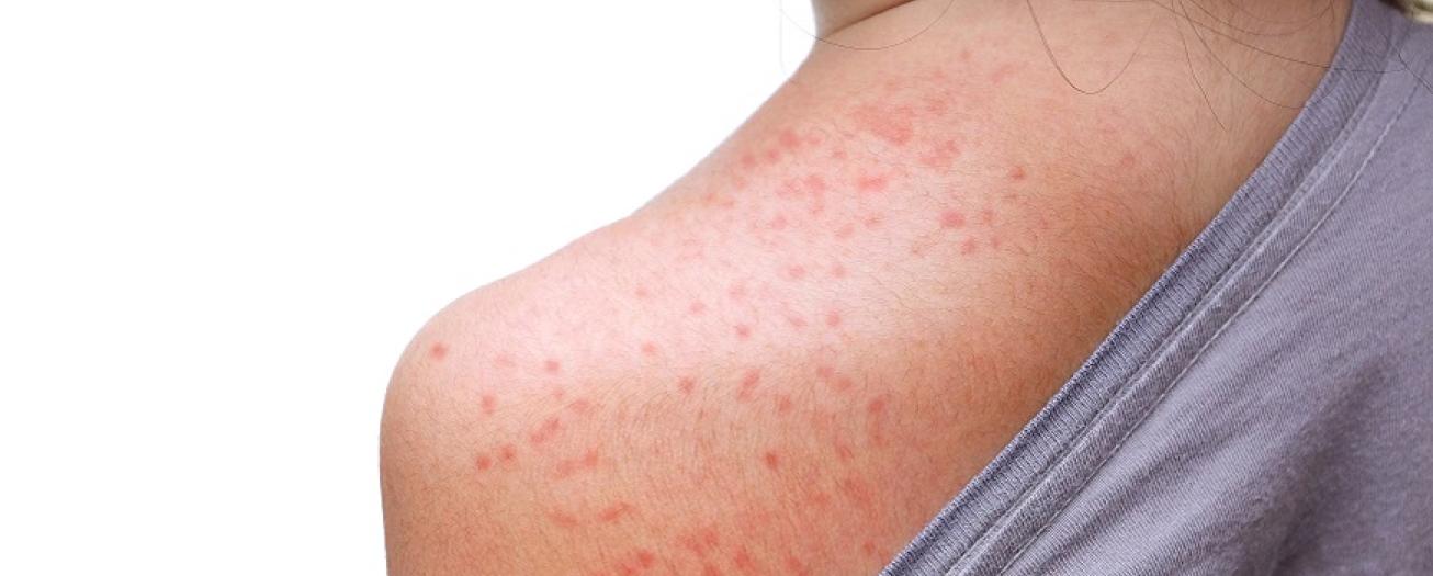  Autoridades de Salud trabajan en seguimiento de alerta internacional por viruela símica