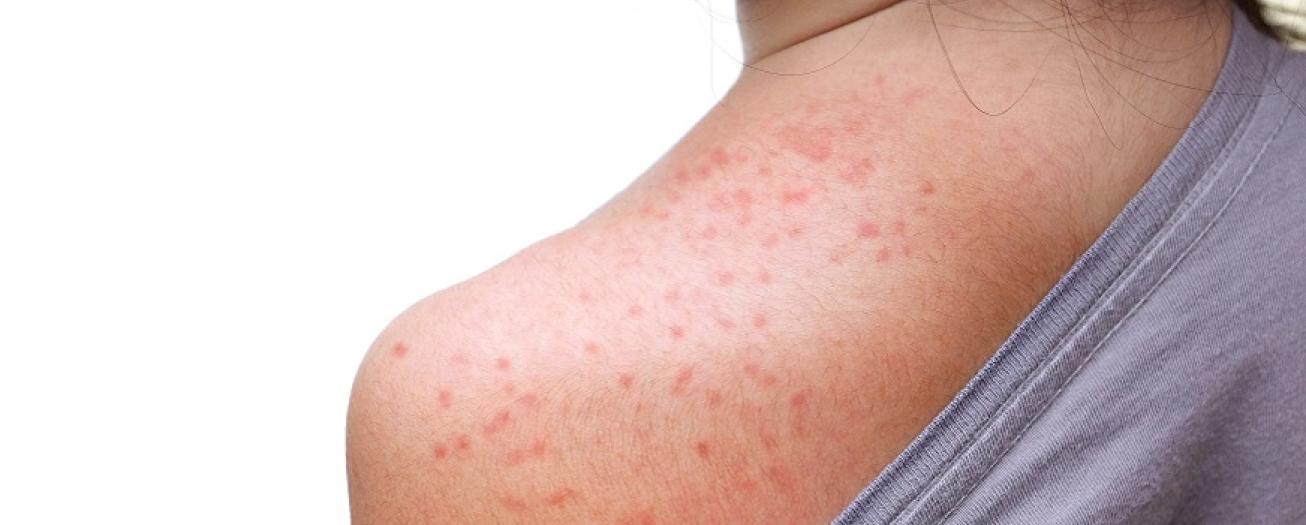 Ministerio de Salud investiga posible caso por viruela símica 