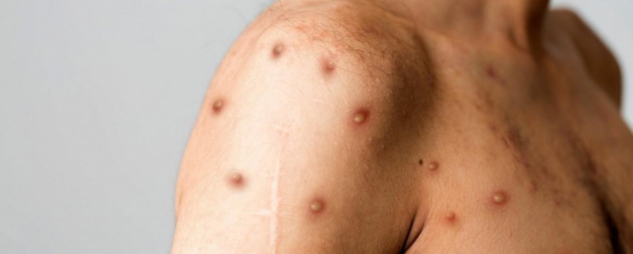 Salud confirma quinto caso de viruela símica